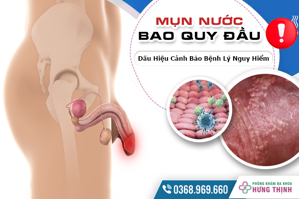  Mụn Nước Bao Quy Đầu - Dấu Hiệu Cảnh Báo Bệnh Lý Nguy Hiểm