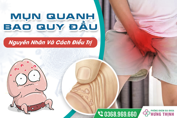 Mụn Quanh Bao Quy Đầu Có Làm Sao Không? Nguyên Nhân Và Cách Điều Trị