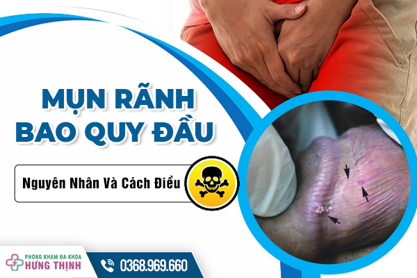 Mụn Rãnh Bao Quy Đầu Có Nguy Hiểm Không? Nguyên Nhân Và Cách Điều Trị