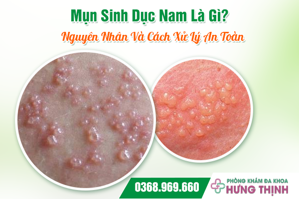 Mụn Sinh Dục Nam Là Gì? Nguyên Nhân Và Cách Xử Lý An Toàn