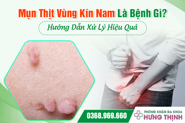 Mụn Thịt Vùng Kín Nam Là Bệnh Gì? Hướng Dẫn Xử Lý Hiệu Quả