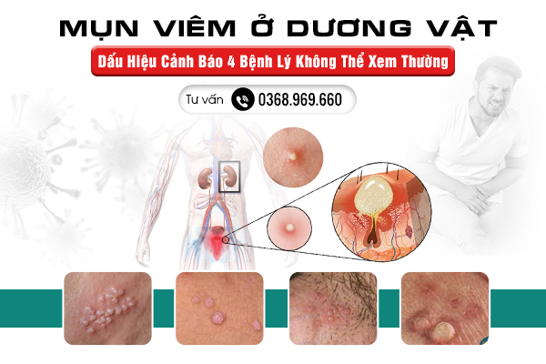  Mụn Viêm Ở Dương Vật - Dấu Hiệu Cảnh Báo 4 Bệnh Lý Không Thể Xem Thường