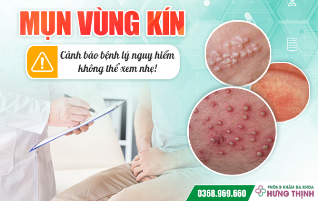 Mụn vùng kín - cảnh báo bệnh lý nguy hiểm không thể xem nhẹ!