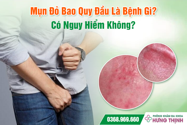 Mụn Đỏ Bao Quy Đầu Là Bệnh Gì? Có Nguy Hiểm Không?