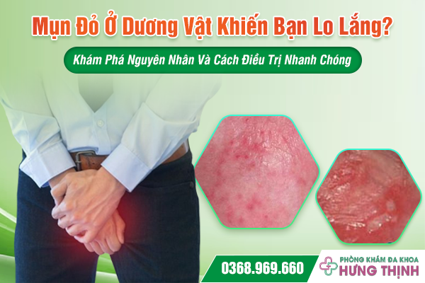 Mụn Đỏ Ở Dương Vật Khiến Bạn Lo Lắng? Khám Phá Nguyên Nhân Và Cách Điều Trị Nhanh Chóng