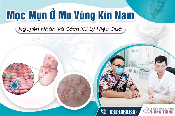 Nguyên Nhân Mọc Mụn Ở Mu Vùng Kín Nam Và Cách Xử Lý Hiệu Quả