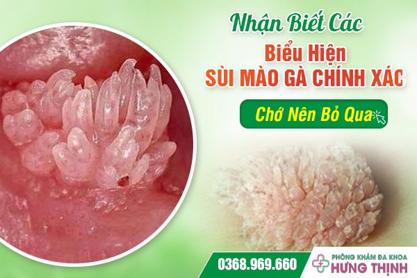 Nhận Biết Các Biểu Hiện Sùi Mào Gà Chính Xác, Chớ Nên Bỏ Qua