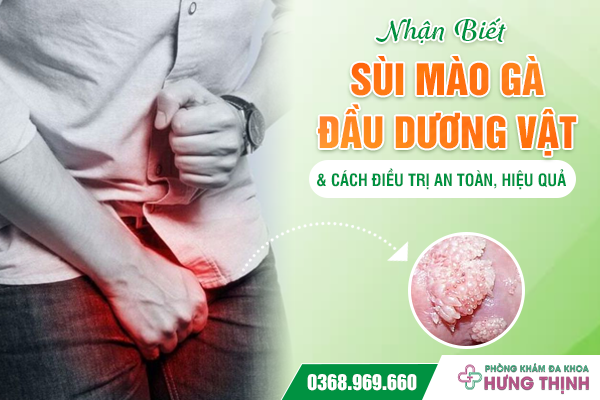Nhận Biết Sùi Mào Gà Đầu Dương Vật Và Cách Điều Trị An Toàn, Hiệu Quả