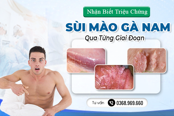 Nhận Biết Triệu Chứng Sùi Mào Gà Nam Qua Từng Giai Đoạn Nhất Định Bạn Phải Biết