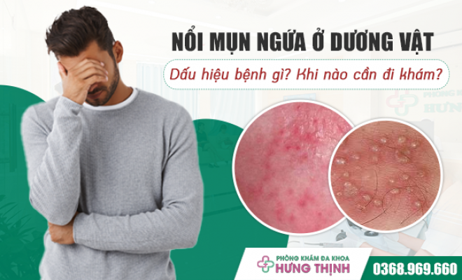 Nổi mụn ngứa ở dương vật - dấu hiệu bệnh gì? Khi nào cần đi khám?