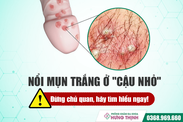 Nổi mụn trắng ở 