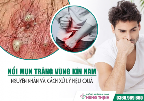 Nổi mụn trắng ở vùng kín nam giới: Nguyên nhân và cách xử lý hiệu quả