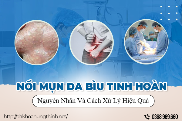  Nổi Mụn Da Bìu Tinh Hoàn Có Sao Không? Nguyên Nhân Và Cách Xử Lý Hiệu Quả