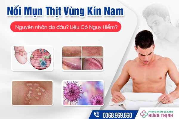 Nổi Mụn Thịt Vùng Kín Nam Do Đâu? Liệu Có Nguy Hiểm?