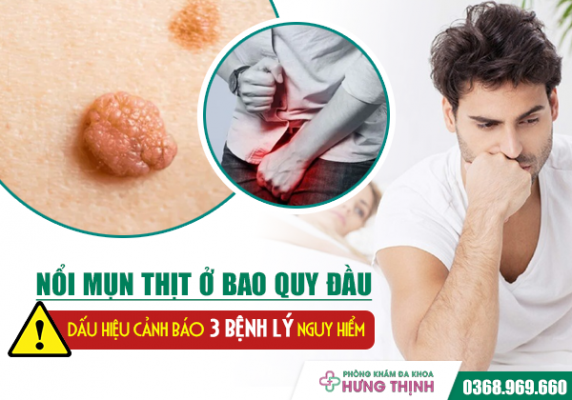 Nổi Mụn Thịt Ở Bao Quy Đầu - Dấu Hiệu Cảnh Báo 3 Bệnh Lý Nguy Hiểm