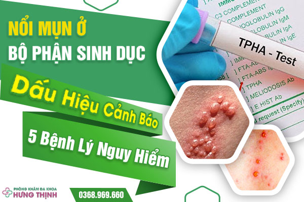 Nổi Mụn Ở Bộ Phận Sinh Dục: Dấu Hiệu Cảnh Báo 5 Bệnh Lý Nguy Hiểm