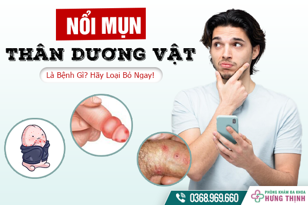 Nổi Mụn Ở Thân Dương Vật Là Bệnh Gì? Hãy Loại Bỏ Ngay!