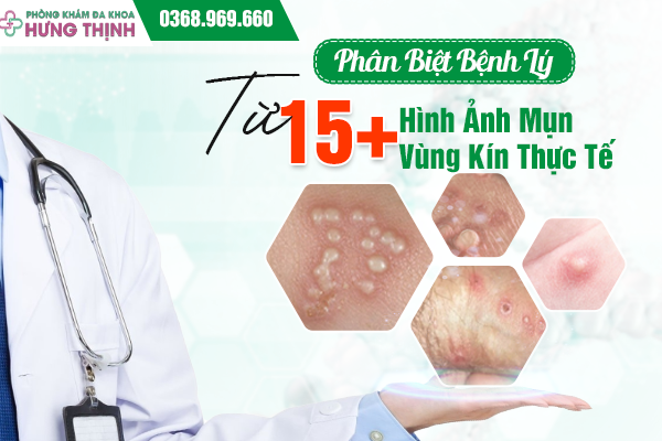 Phân Biệt Bệnh Lý Từ 15+ Hình Ảnh Mụn Vùng Kín Thực Tế
