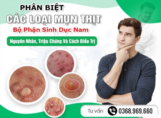 Phân Biệt Các Loại Mụn Thịt Ở Bộ Phận Sinh Dục Nam: Nguyên Nhân, Triệu Chứng Và Cách Điều Trị