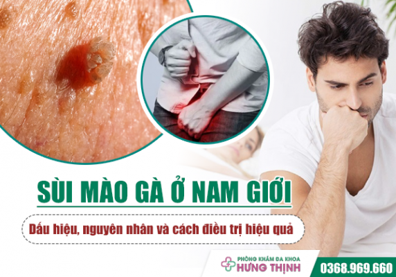 Sùi mào gà ở nam giới: Dấu hiệu, nguyên nhân và cách điều trị hiệu quả