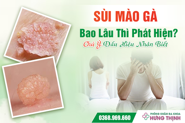 Sùi Mào Gà Bao Lâu Thì Phát Hiện? Chú Ý Dấu Hiệu Nhận Biết