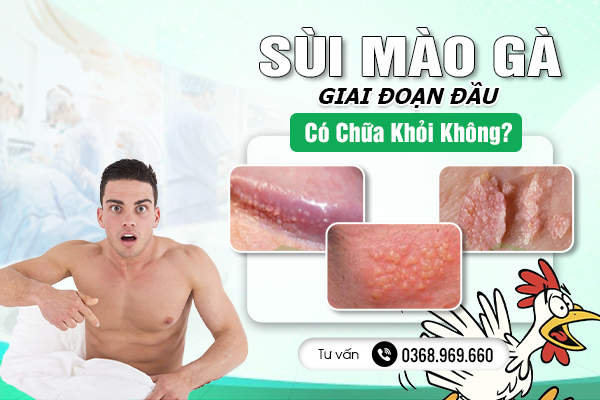 Sùi Mào Gà Giai Đoạn Đầu Có Chữa Khỏi Không? Tìm Hiểu Ngay