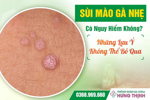 Sùi Mào Gà Nhẹ Có Nguy Hiểm Không? Những Lưu Ý Không Thể Bỏ Qua