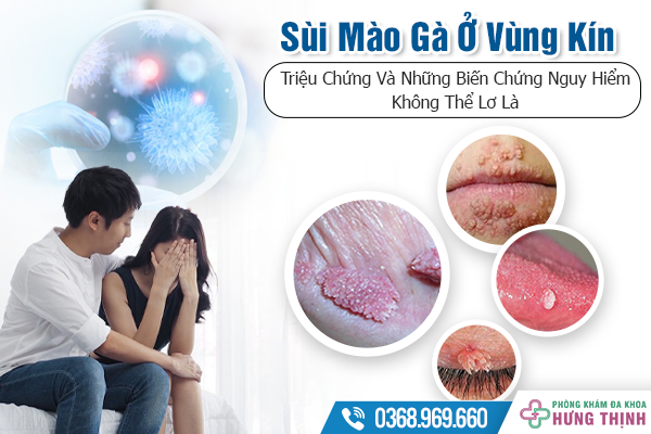 Sùi Mào Gà Ở Vùng Kín - Triệu Chứng Và Những Biến Chứng Nguy Hiểm Không Thể Lơ Là