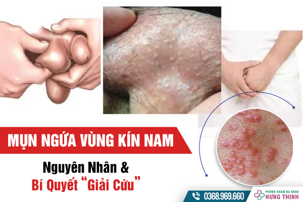 Tiết Lộ Nguyên Nhân Và Bí Quyết “Giải Cứu” Tình Trạng Mụn Ngứa Ở Vùng Kín Nam