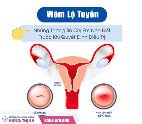 Viêm Lộ Tuyến: Những Thông Tin Chị Em Nên Biết Trước Khi Quyết Định Điều Trị