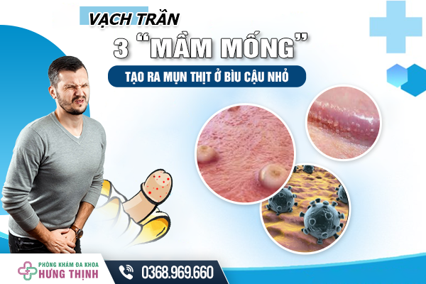 Vạch Trần 3 “Mầm Mống” Tạo Ra Mụn Thịt Ở Bìu Cậu Nhỏ 