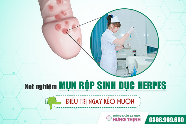 Xét nghiệm mụn rộp sinh dục herpes: Câu trả lời cho mọi nghi ngờ