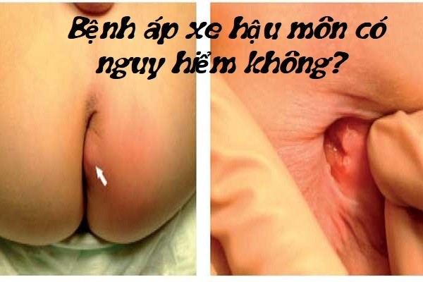 Áp xe hậu môn có nguy hiểm không