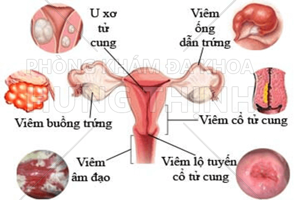 Viêm phụ khoa và những dấu hiệu nhận biết