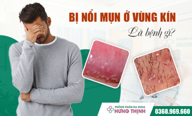 Bị Nổi Mụn Ở Vùng Kín Là Bệnh Gì? Nguy Hiểm Tiềm Ẩn Và Cách Phòng Ngừa Hiệu Quả