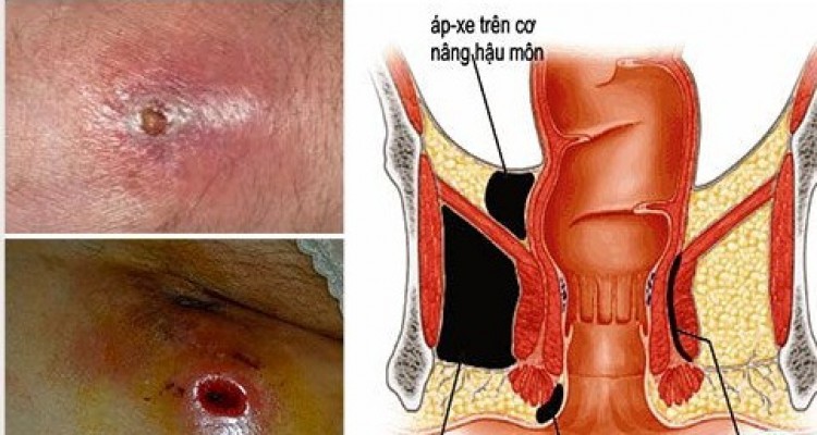 Các cách điều trị áp xe hậu môn hiệu quả 