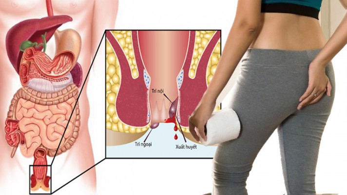 Nhận biết 4 cấp độ của bệnh trĩ và cách chữa trị hiệu quả