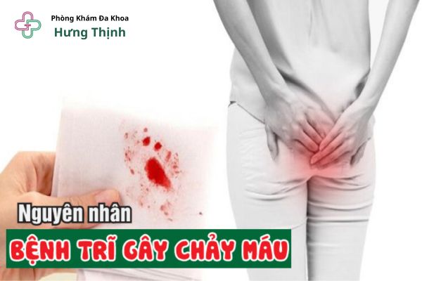 Bệnh trĩ ra máu - Đừng chủ quan - Nguyên nhân, triệu chứng và cách điều trị