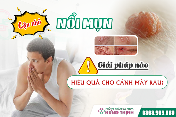 Cậu Nhỏ Nổi Mụn Là Bệnh Gì? Giải Pháp Nào Hiệu Quả Cho Cánh Mày Râu?