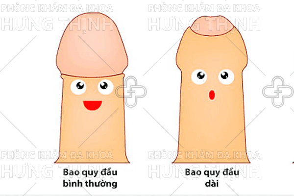 Dài bao quy đầu là gì - nguyên nhân và cách chữa dài bao quy đầu