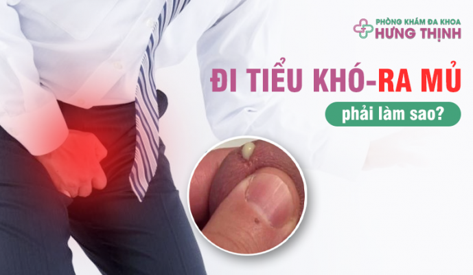 Đi Tiểu Khó, Tiểu Buốt Ra Mủ - Dương Vật Ra Dịch Mủ Trắng Phải Làm Sao?