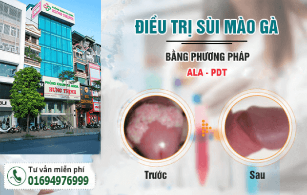 Nguyên nhân, triệu chứng, tác hại và phương pháp điều trị bệnh sùi mào gà