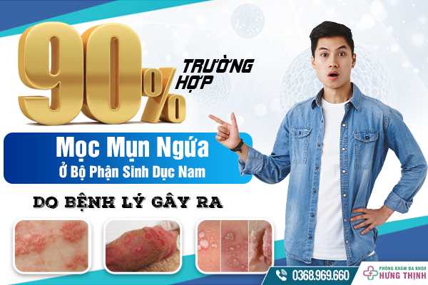 90% Trường Hợp Mọc Mụn Ngứa Ở Bộ Phận Sinh Dục Nam Giới Do Bệnh Lý Gây Ra