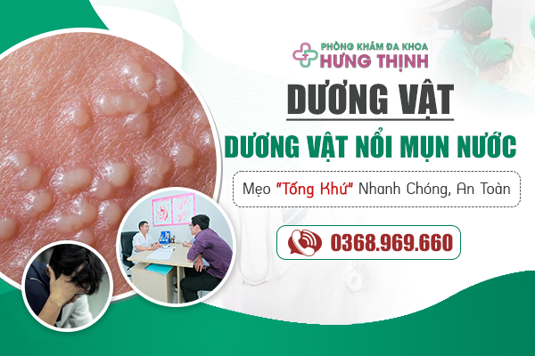 Dương Vật Nổi Mụn Nước Là Bệnh Gì? Mẹo “Tống Khứ” Mụn Nước Nhanh Chóng, An Toàn