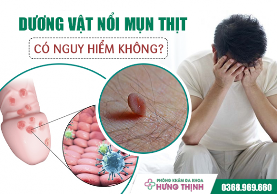 Dương Vật Nổi Mụn Thịt Có Nguy Hiểm Không? Cảnh Báo 4 Bệnh Lý Nguy Hiểm