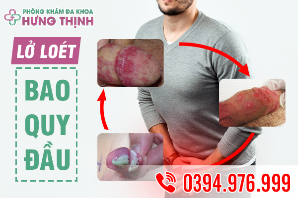 LOÉT BAO QUY ĐẦU: DẤU HIỆU BỆNH NAM KHOA NGUY HIỂM Ở NAM GIỚI