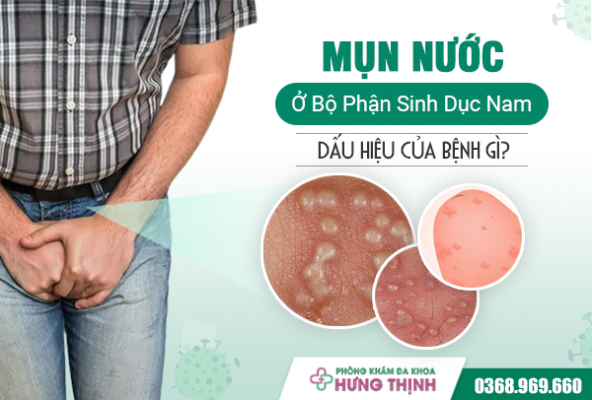 Mọc Mụn Nước Ở Bộ Phận Sinh Dục Nam Dấu Hiệu Của Bệnh Gì?