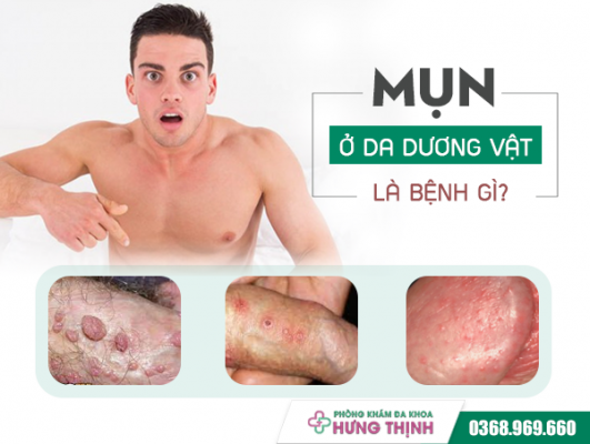 Mụn Ở Da Dương Vật Là Bệnh Gì? Những Điều Cần Lưu Ý Khi Điều Trị