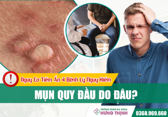 Mụn Quy Đầu Do Đâu? Nguy Cơ Tiềm Ẩn 4 Bệnh Lý Nguy Hiểm Ở Nam Giới