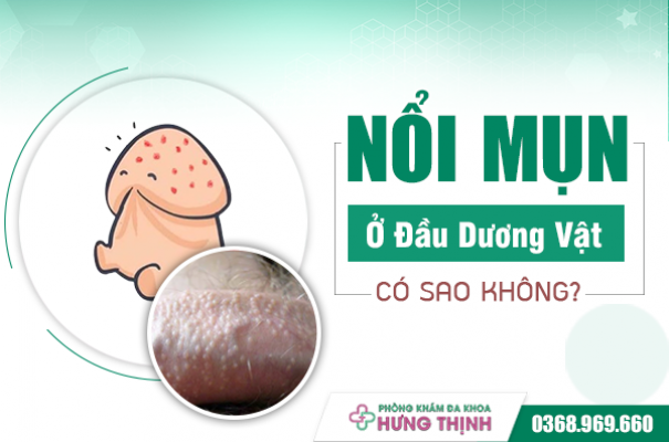 Nổi Mụn Ở Đầu Dương Vật Có Làm Sao Không? 3 Cách Chữa Trị An Toàn, Hiệu Quả Tức Thì